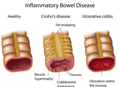 Biological therapy in Crohn's disease